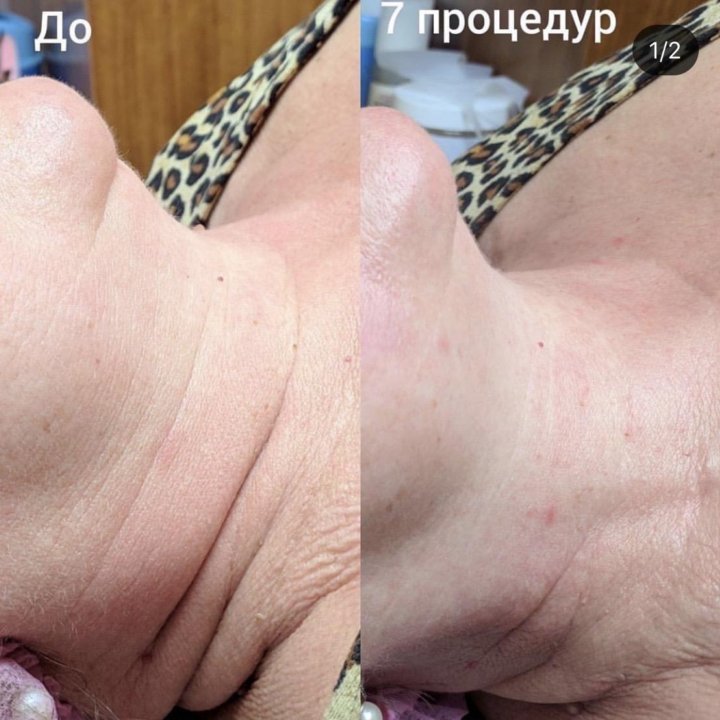 Flaxlift, Молодость без уколов,Акне Обучение!!!