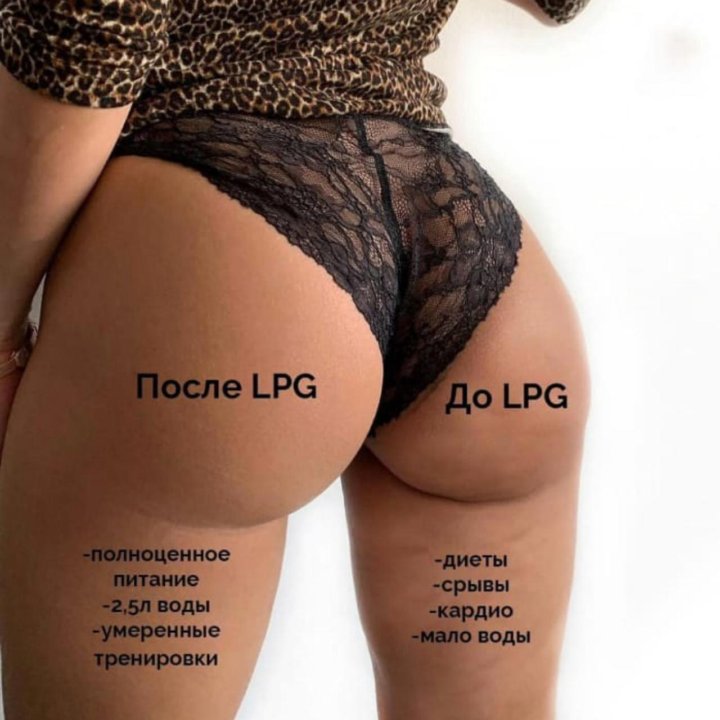 Массаж LPG