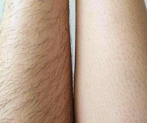 Шугаринг / ваксинг