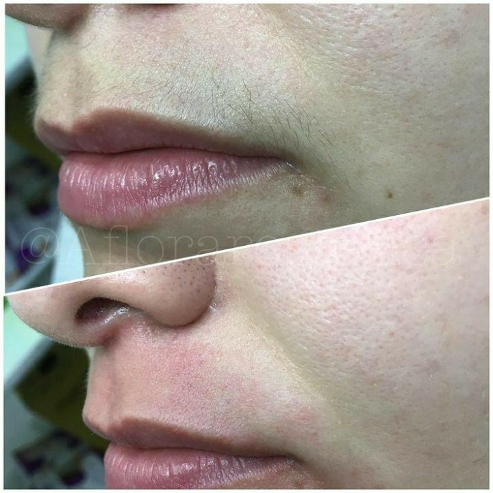 Шугаринг / ваксинг