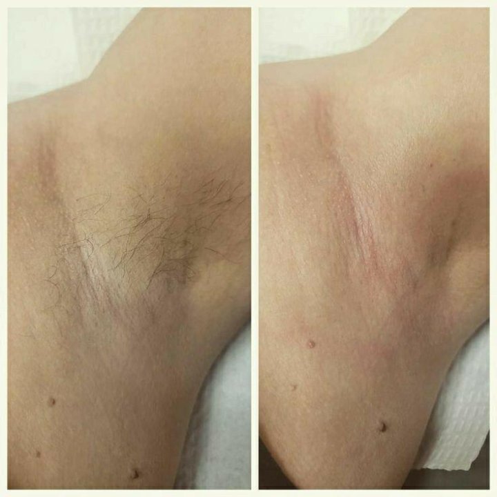 Шугаринг / ваксинг