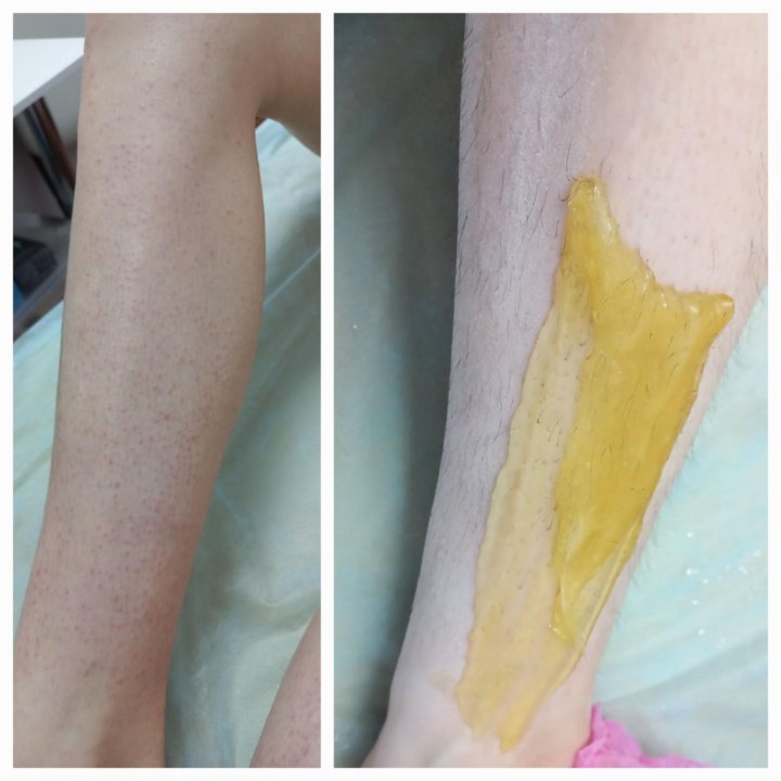 Шугаринг / ваксинг