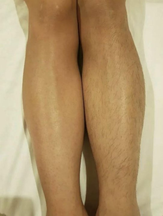 До и после шугаринга фото ног