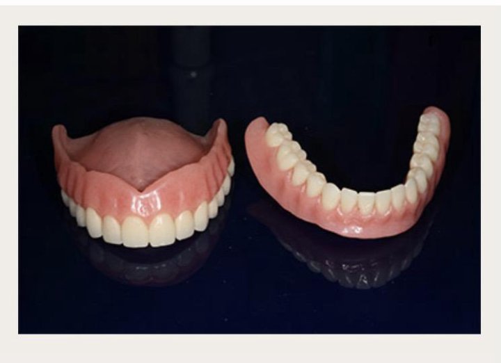 Какие зубные протезы лучше при отсутствии зубов. Ацеталовый съемный протез. Вставная челюсть на присосках. Протезы зубов на присосках.
