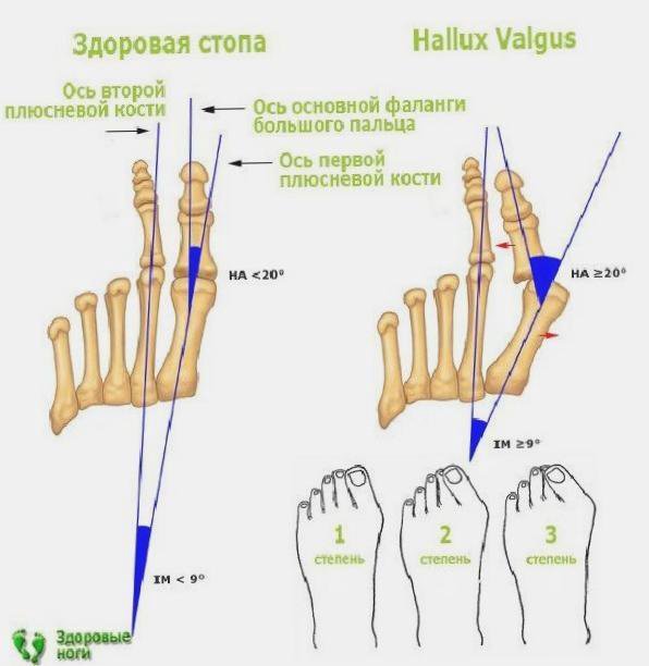 Деформация пальцев стопы мкб. Классификация халюкс вальгус. Hallux valgus 1 степени стопы что это. Степень деформации халюкс вальгус.