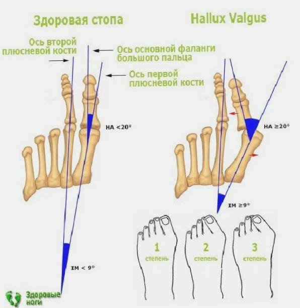 Углы стопы. Степень деформации халюкс вальгус. Hallux valgus угол отклонения. Халюс вальгус рентген степени.