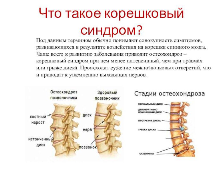 Корешки поясничного отдела. Корешки и позвонки. Корешковый остеохондроз. Корешковые отверстия позвоночника.