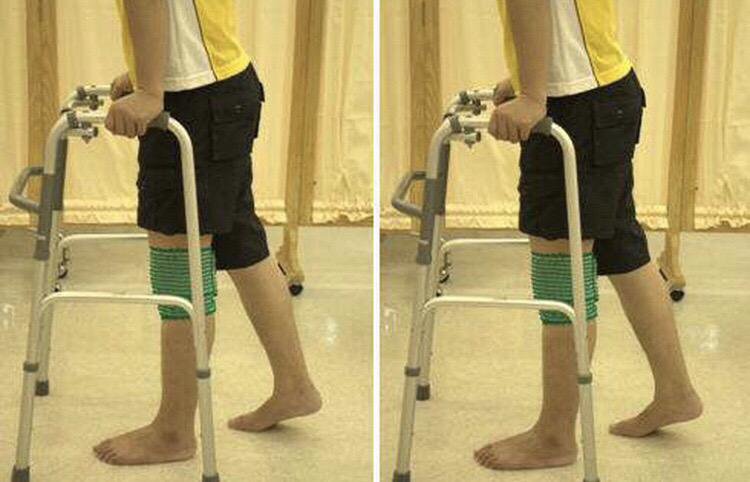 Встать на колено после эндопротезирования. Костыли при переломе бедра. Реабилитация на костылях. Костыли при переломе голени. Приспособление для ходьбы на костылях.