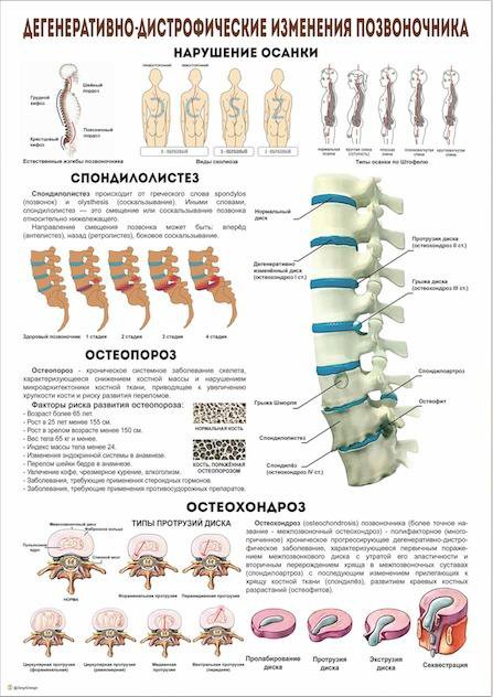 Изменения позвоночника. Дегенеративные изменения позвоночника. Дегенеративно-дистрофические изменения позвоночника плакат. Возрастные изменения позвоночника называются.